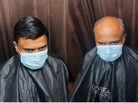 Hair patch transformation