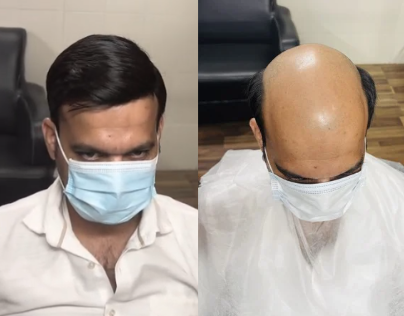 Hair patch transformation